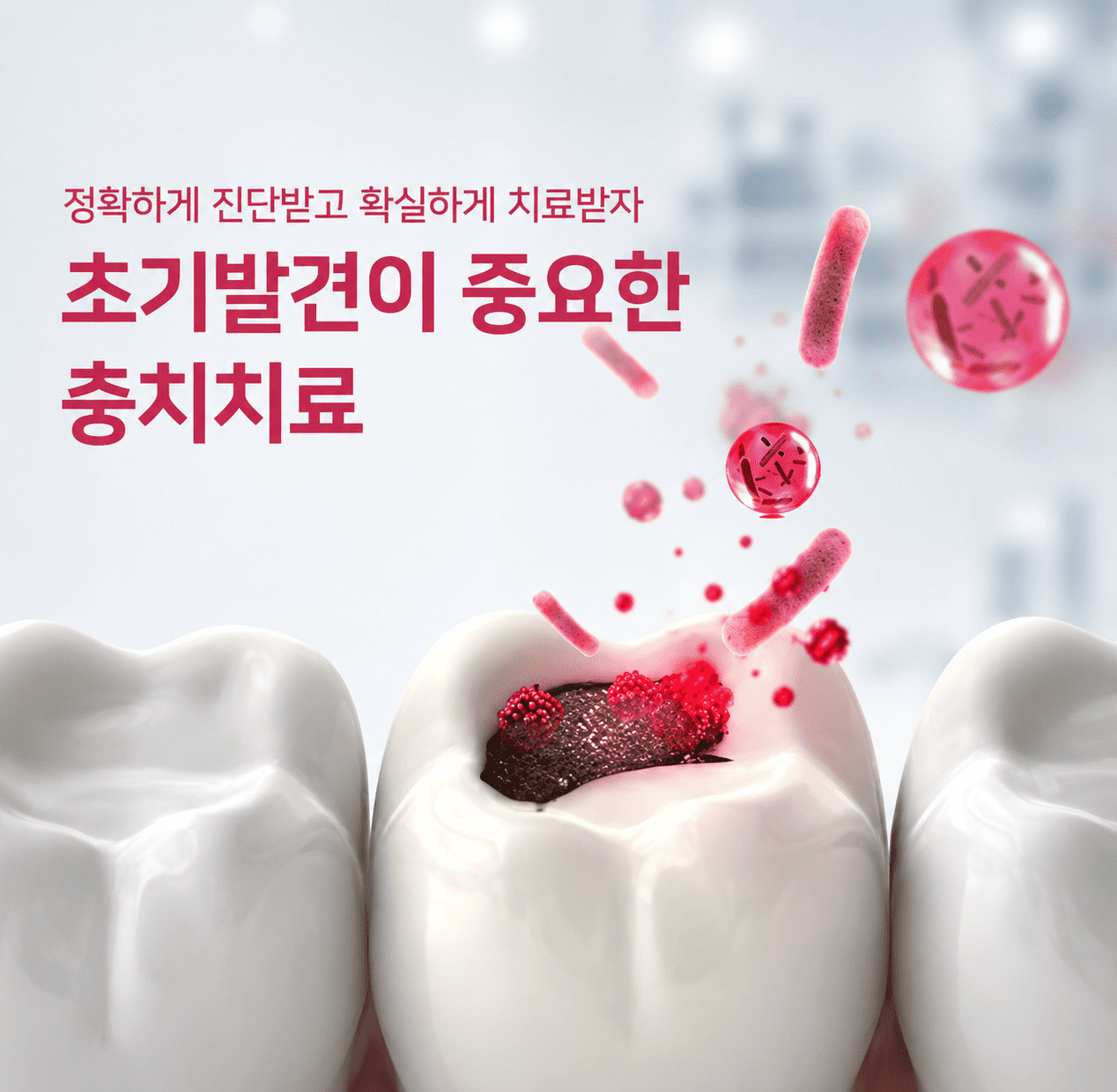 연세채움 충치 치료